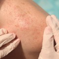 How Long Does an Allergic Reaction to Pet Dander Last? - An Expert's Guide